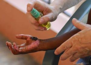 MMS topical spray on an abrasion wound.