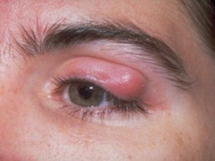 chalazion-1[1]